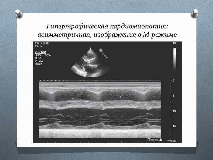 Гипертрофическая кардиомиопатия: асимметричная, изображение в М-режиме 