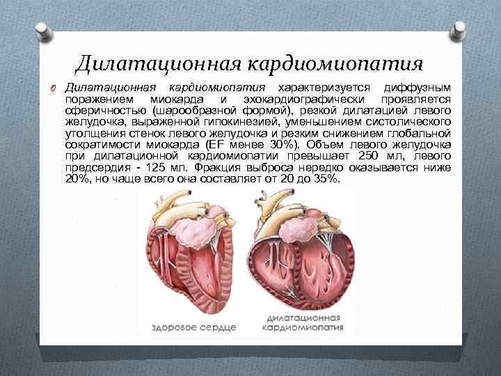 Дилатационная кардиомиопатия O Дилатационная кардиомиопатия характеризуется диффузным поражением миокарда и эхокардиографически проявляется сферичностью (шарообразной