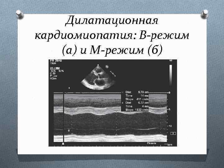 Дилатационная кардиомиопатия: В-режим (а) и М-режим (б) 