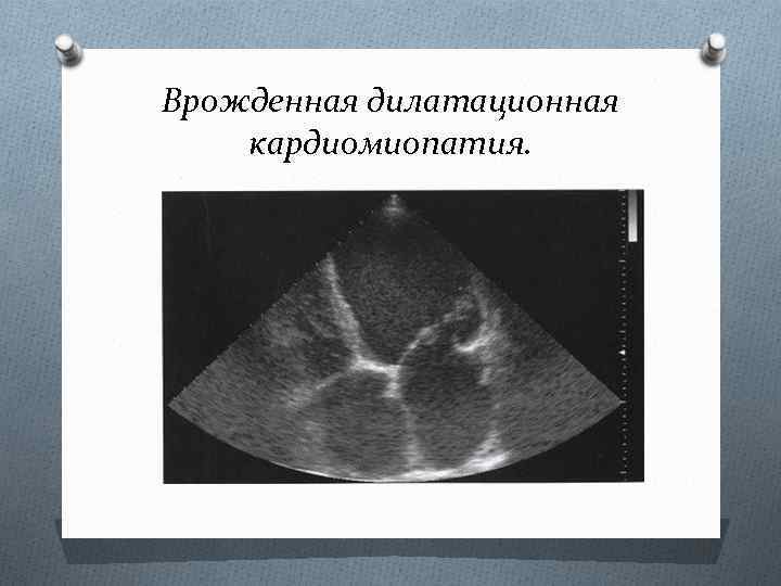 Врожденная дилатационная кардиомиопатия. 