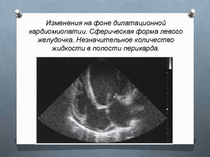 Изменения на фоне дилатационной кардиомиопатии. Сферическая форма левого желудочка. Незначительное количество жидкости в полости