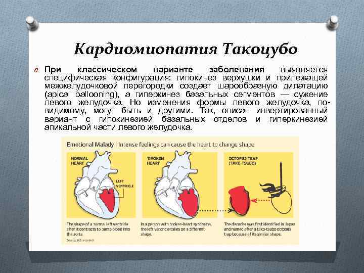 Кардиомиопатия Такоцубо O При классическом варианте заболевания выявляется специфическая конфигурация: гипокинез верхушки и прилежащей