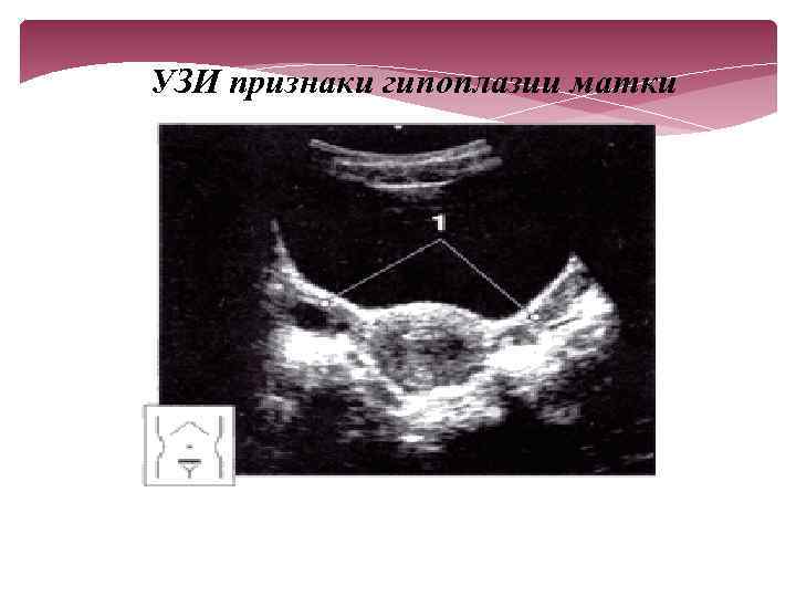 УЗИ признаки гипоплазии матки 