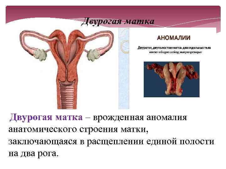 Двурогая матка – врожденная аномалия анатомического строения матки, заключающаяся в расщеплении единой полости на