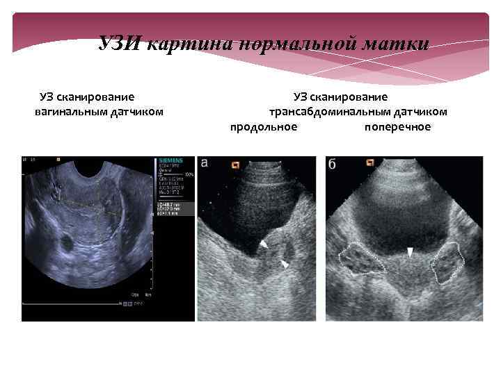 УЗИ картина нормальной матки УЗ сканирование вагинальным датчиком УЗ сканирование трансабдоминальным датчиком продольное поперечное