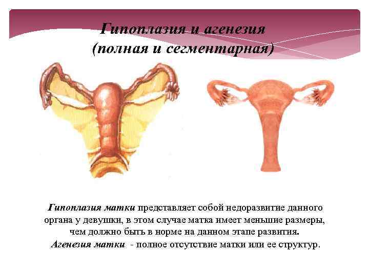 Гипоплазия и агенезия (полная и сегментарная) Гипоплазия матки представляет собой недоразвитие данного органа у