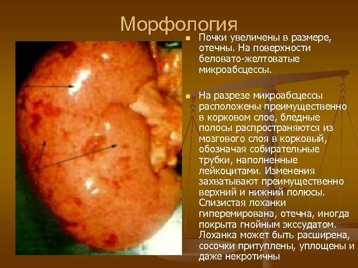Морфология Почки увеличены в размере, n n отечны. На поверхности беловато-желтоватые микроабсцессы. На разрезе
