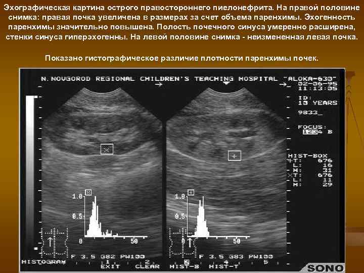 Эхографическая картина острого правостороннего пиелонефрита. На правой половине снимка: правая почка увеличена в размерах