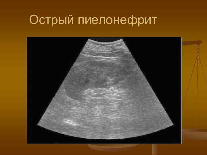 Острый пиелонефрит 