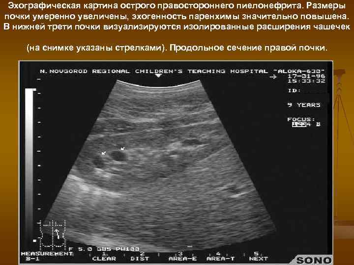 Эхографическая картина острого правостороннего пиелонефрита. Размеры почки умеренно увеличены, эхогенность паренхимы значительно повышена. В