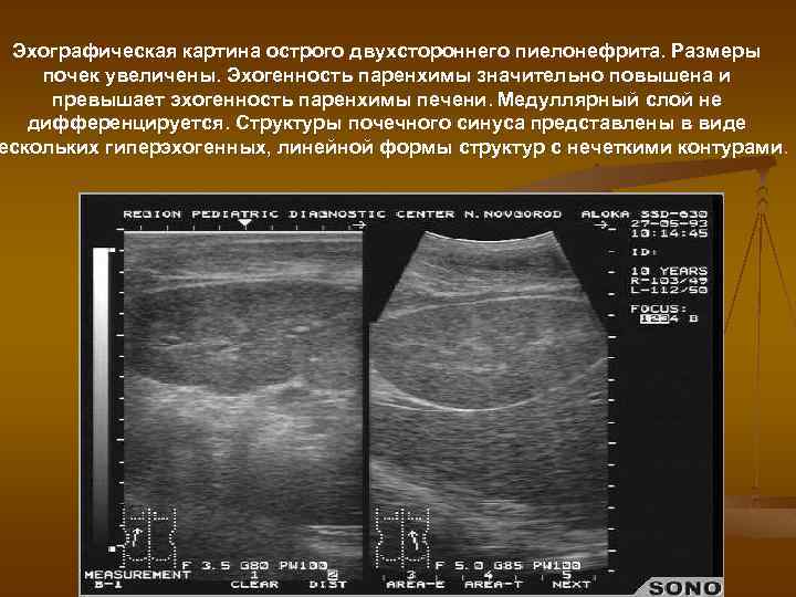 Эхографическая картина острого двухстороннего пиелонефрита. Размеры почек увеличены. Эхогенность паренхимы значительно повышена и превышает