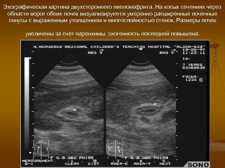 Эхографическая картина двухстороннего пиелонефрита. На косых сечениях через области ворот обеих почек визуализируются умеренно