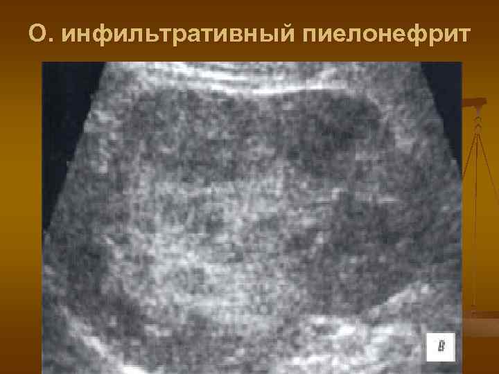 О. инфильтративный пиелонефрит 