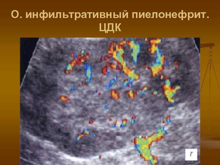 О. инфильтративный пиелонефрит. ЦДК 