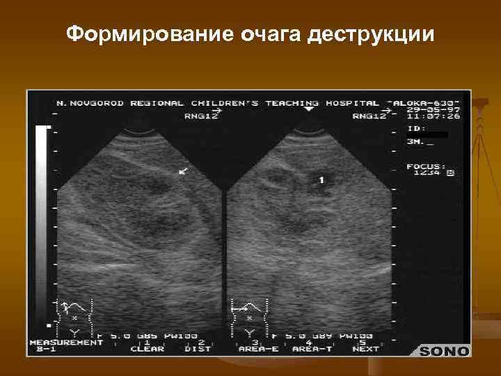 Формирование очага деструкции 