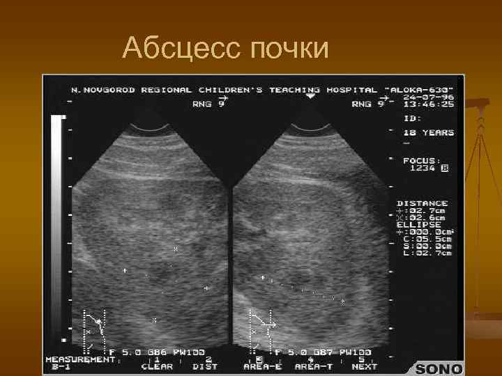 Абсцесс почки 