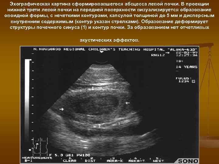 Эхографическая картина сформировавшегося абсцесса левой почки. В проекции нижней трети левой почки на передней