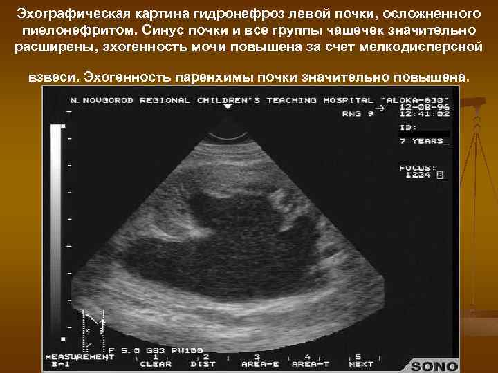 Эхографическая картина гидронефроз левой почки, осложненного пиелонефритом. Синус почки и все группы чашечек значительно