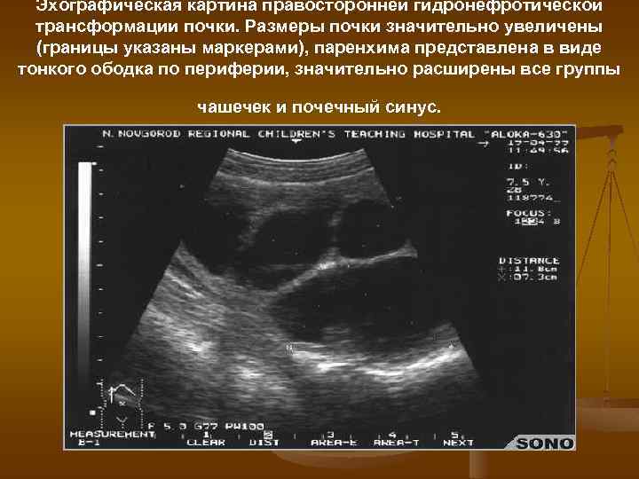 Эхографическая картина правосторонней гидронефротической трансформации почки. Размеры почки значительно увеличены (границы указаны маркерами), паренхима