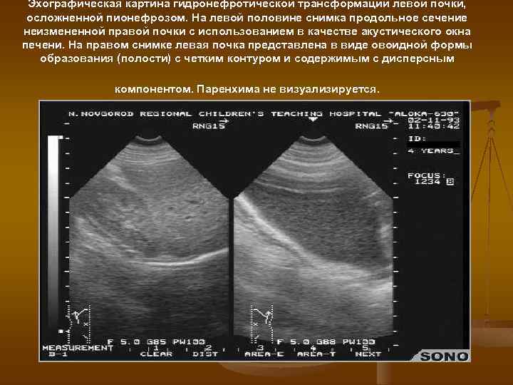 Эхографическая картина гидронефротической трансформации левой почки, осложненной пионефрозом. На левой половине снимка продольное сечение