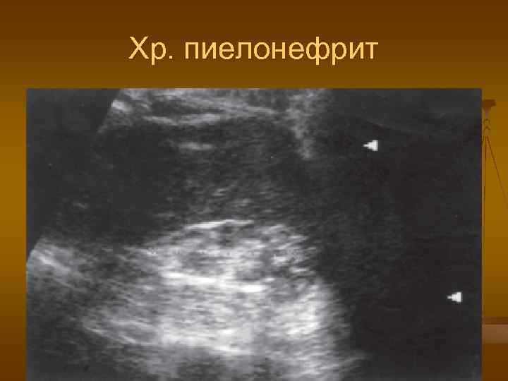 Хр. пиелонефрит 