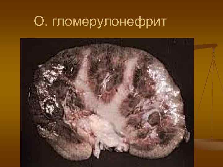 О. гломерулонефрит 