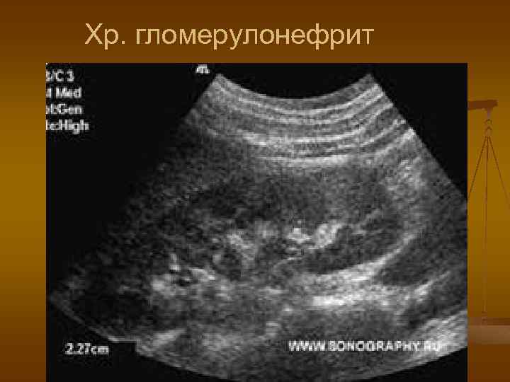 Хр. гломерулонефрит 