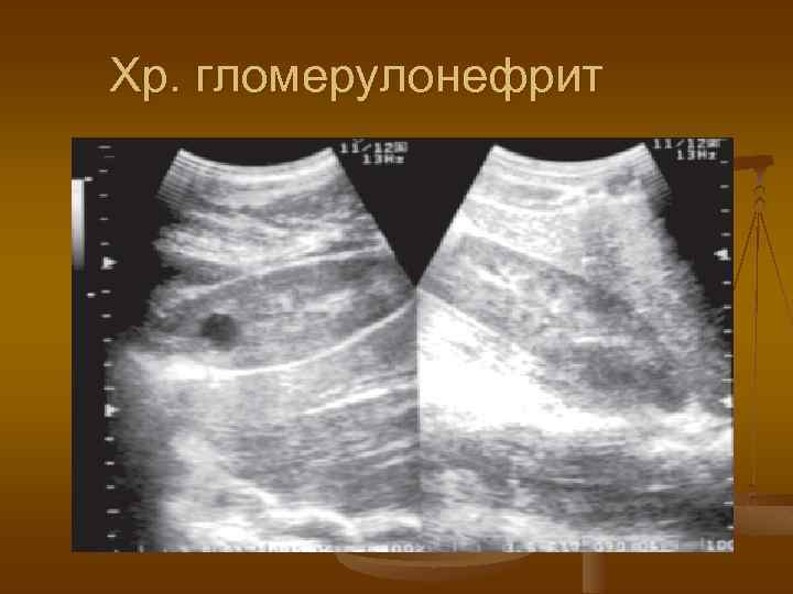 Хр. гломерулонефрит 