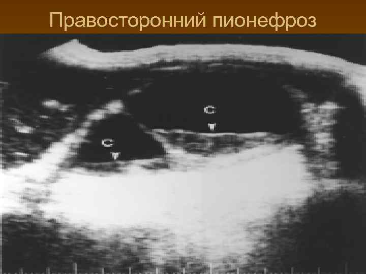 Правосторонний пионефроз 