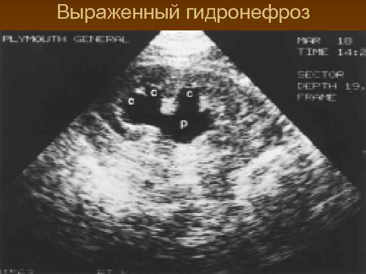 Выраженный гидронефроз 