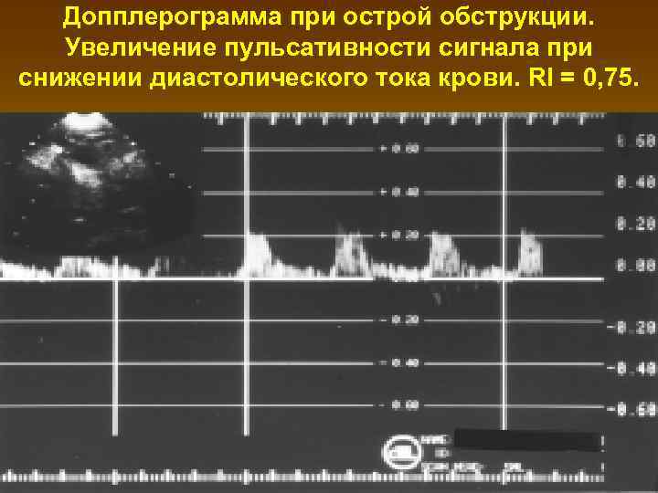 Допплерограмма при острой обструкции. Увеличение пульсативности сигнала при снижении диастолического тока крови. RI =