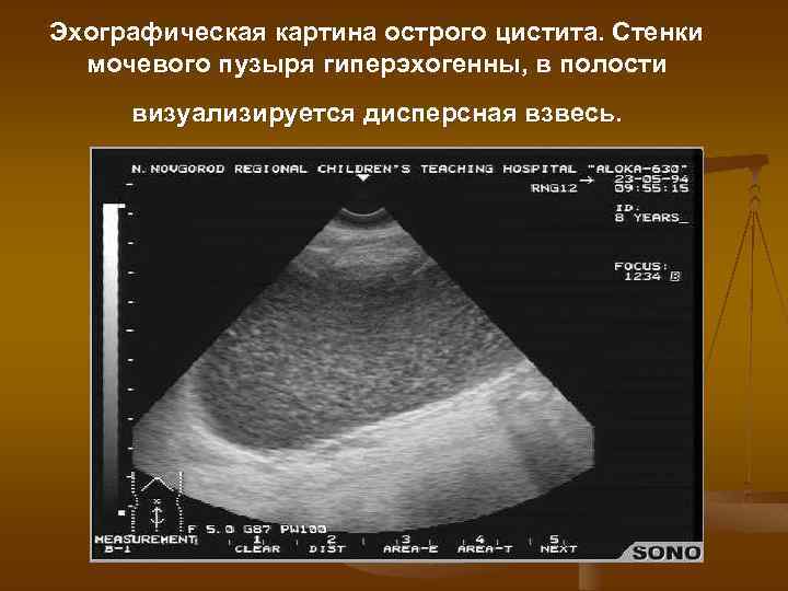 Эхографическая картина острого цистита. Стенки мочевого пузыря гиперэхогенны, в полости визуализируется дисперсная взвесь. 