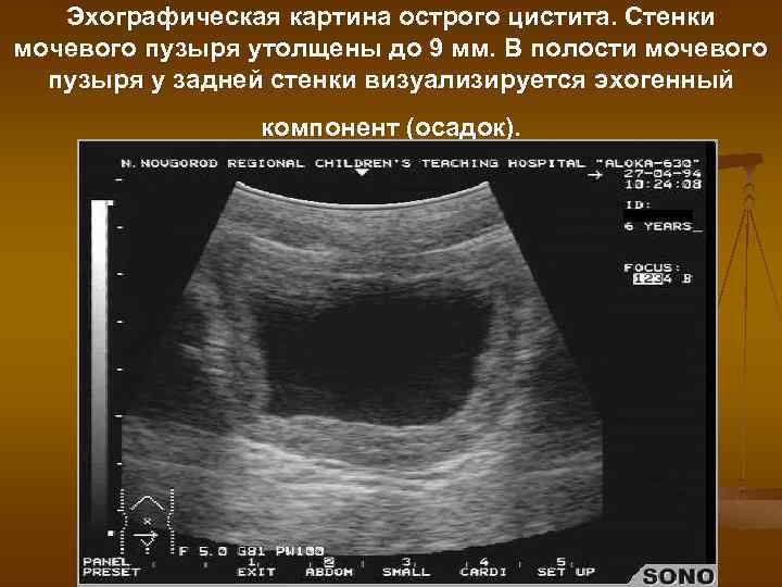Эхографическая картина острого цистита. Стенки мочевого пузыря утолщены до 9 мм. В полости мочевого