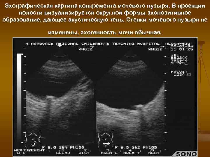 Эхографическая картина конкремента мочевого пузыря. В проекции полости визуализируется округлой формы эхопозитивное образование, дающее