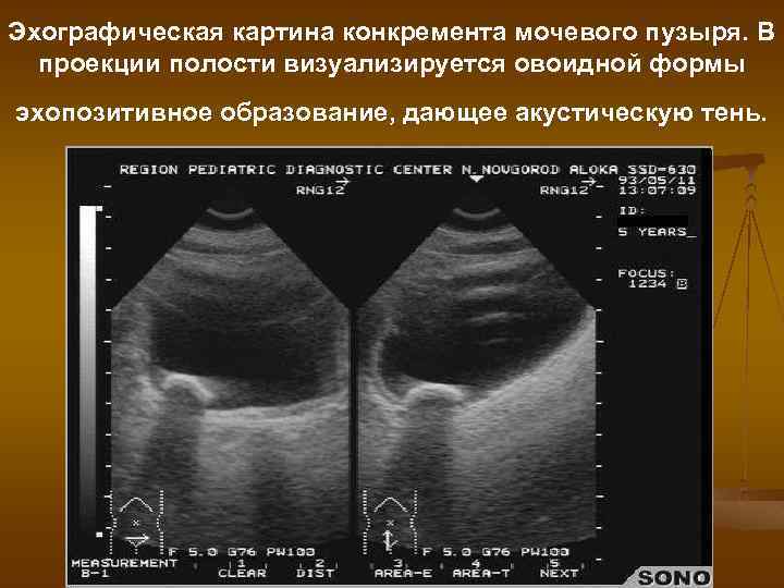 Эхографическая картина конкремента мочевого пузыря. В проекции полости визуализируется овоидной формы эхопозитивное образование, дающее