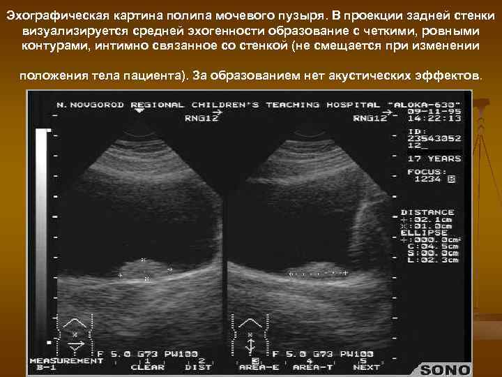 Эхографическая картина полипа мочевого пузыря. В проекции задней стенки визуализируется средней эхогенности образование с