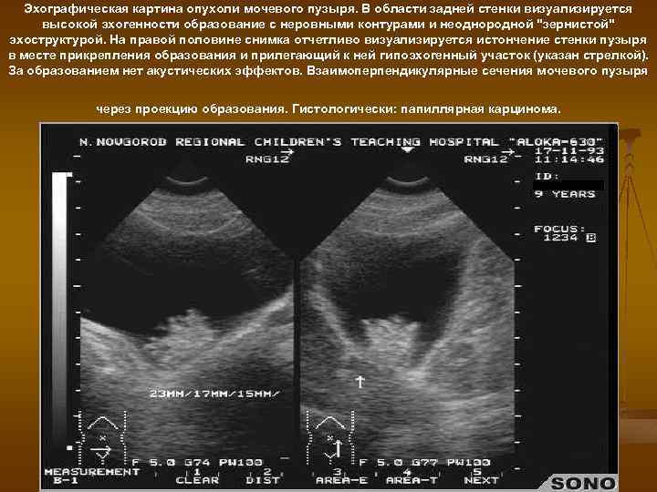 Эхографическая картина опухоли мочевого пузыря. В области задней стенки визуализируется высокой эхогенности образование с