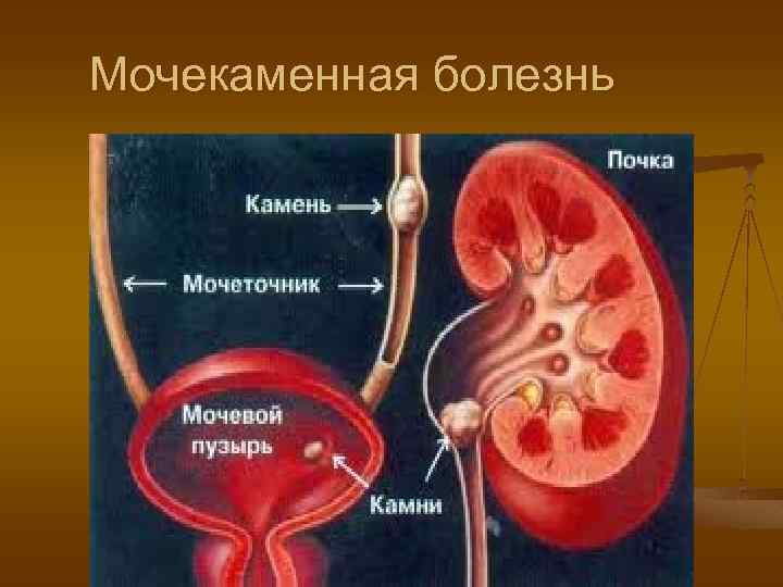 Мочекаменная болезнь 