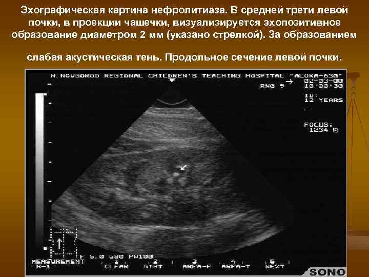 Эхографическая картина нефролитиаза. В средней трети левой почки, в проекции чашечки, визуализируется эхопозитивное образование