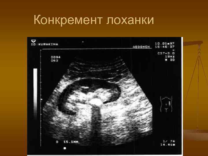 Конкремент лоханки 