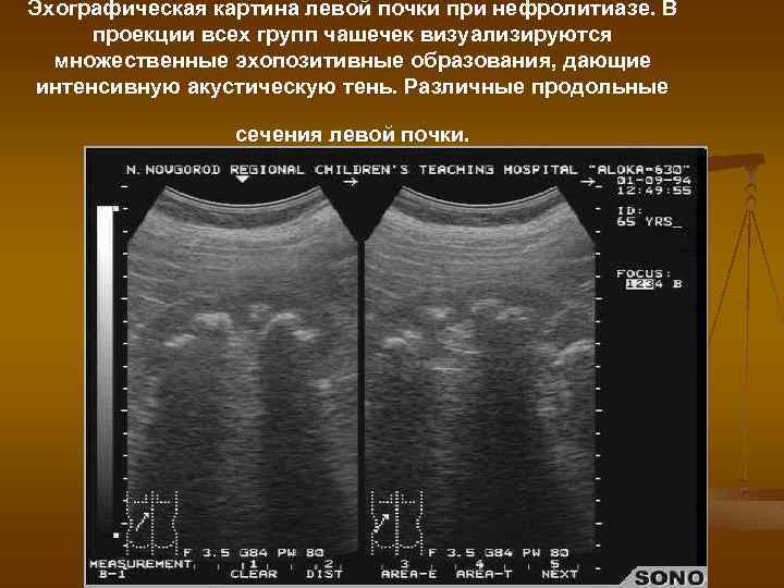 Эхографическая картина левой почки при нефролитиазе. В проекции всех групп чашечек визуализируются множественные эхопозитивные