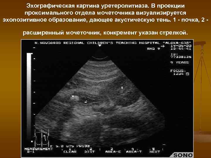 Эхографическая картина уретеролитиаза. В проекции проксимального отдела мочеточника визуализируется эхопозитивное образование, дающее акустическую тень.