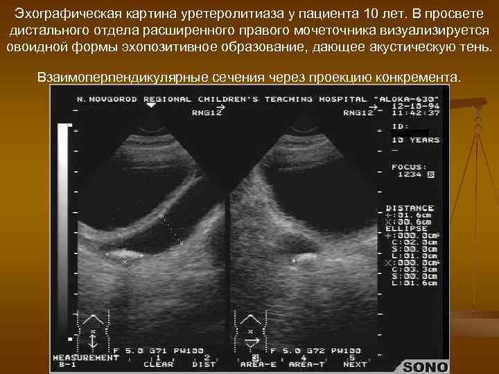 Эхографическая картина уретеролитиаза у пациента 10 лет. В просвете дистального отдела расширенного правого мочеточника