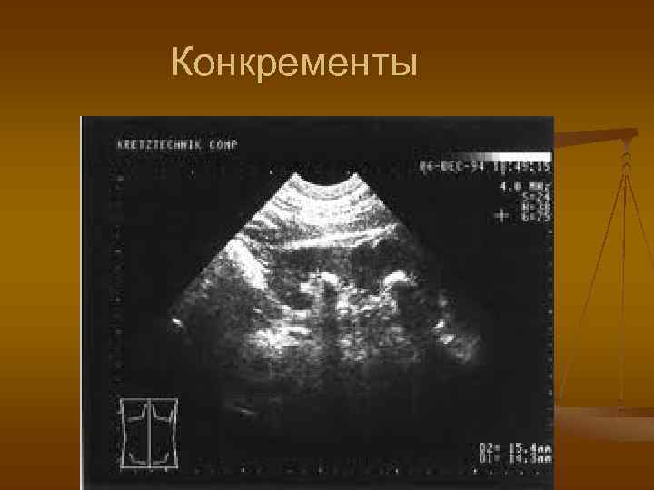 Конкременты 