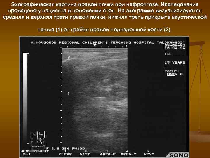 Эхографическая картина правой почки при нефроптозе. Исследование проведено у пациента в положении стоя. На