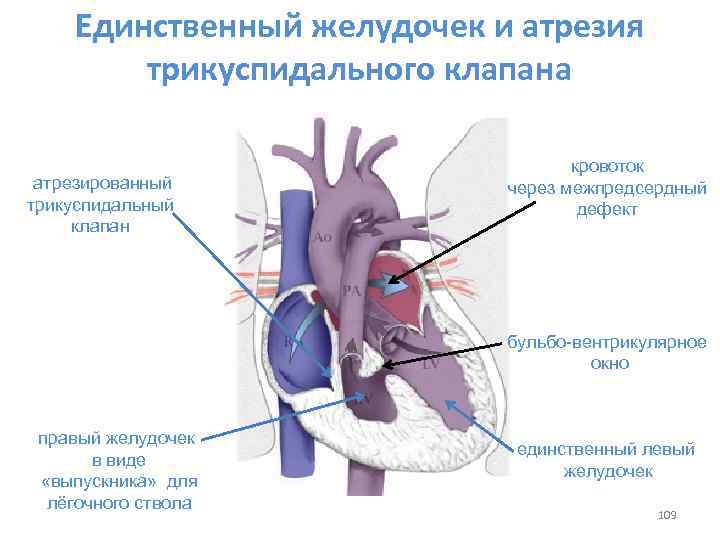 Пластика трикуспидального клапана