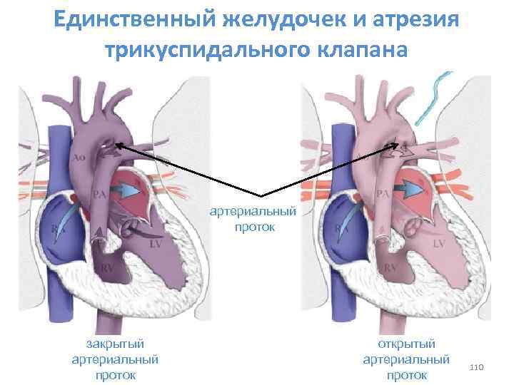 Недостаточность трикуспидального клапана степени