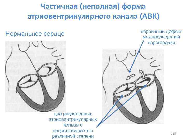 Атриовентрикулярный дефект