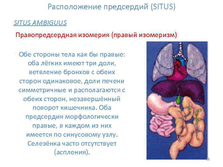 Расположение предсердий (SITUS) SITUS AMBIGUUS Правопредсердная изомерия (правый изомеризм) Обе стороны тела как бы