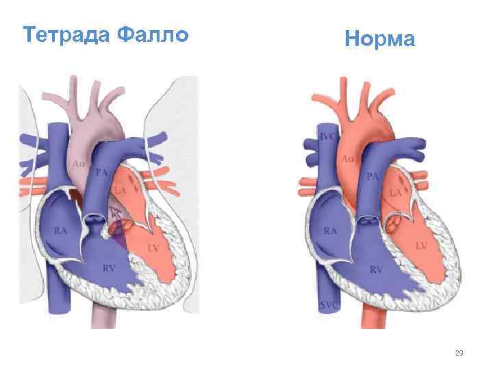 Тетрада Фалло Норма 29 